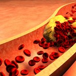 Wysoki cholesterol sprzyja rozwojowi nowotworów. Zaskakujące wyniki badań