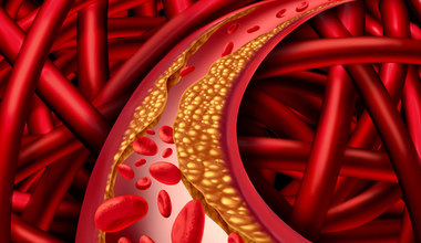 Wysoki poziom cholesterolu - czerwona lampa dla zdrowia 