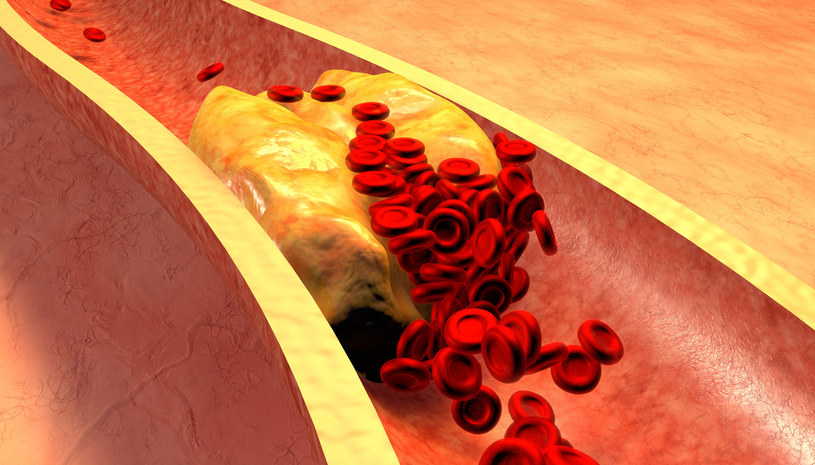Wysoki poziom cholesterolu ma już ponad 20 mln Polaków. /123RF/PICSEL