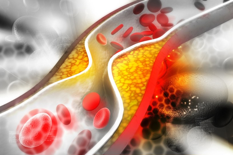 Wysoki poziom złego cholesterolu może doprowadzić do rozwoju miażdżycy /123RF/PICSEL