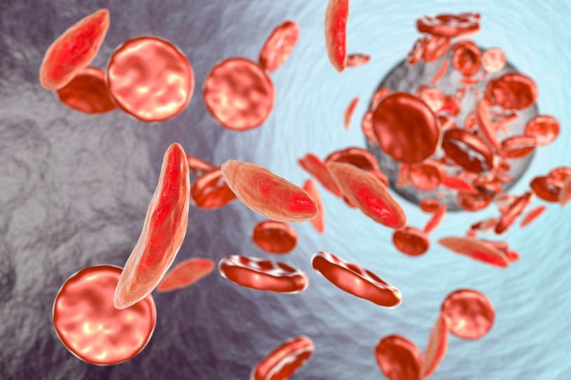 Z anemią sierpowatą się rodzimy (lustracja przedstawia naczynia krwionośne z normalnymi i zdeformowanymi czerwonymi krwinkami przypominającymi półksiężyc w anemii sierpowatej) /123RF/PICSEL