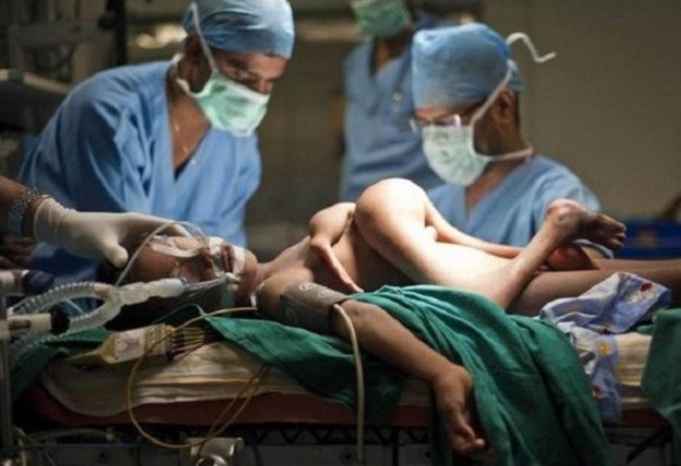 Z brzucha Deepaka Paswaana Kumara z Indii wystawały ręce, nogi i korpus jego syjamskiego brata bliźniaka. Takie choroby to nie efekt genów? (Fot. blog.asiantown.net) /materiały prasowe