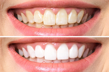 Z jasnymi zębami Ci do twarzy – o metodach rozjaśniania i wybielania