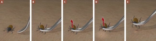 Za pomocą pęsety (najlepiej zakrzywionej) uchwyć kleszcza za główkę jak najbliżej skóry. Usuń kleszcza poprzez pociąganie go jednostajnym ruchem pionowo do góry /Medycyna Praktyczna /