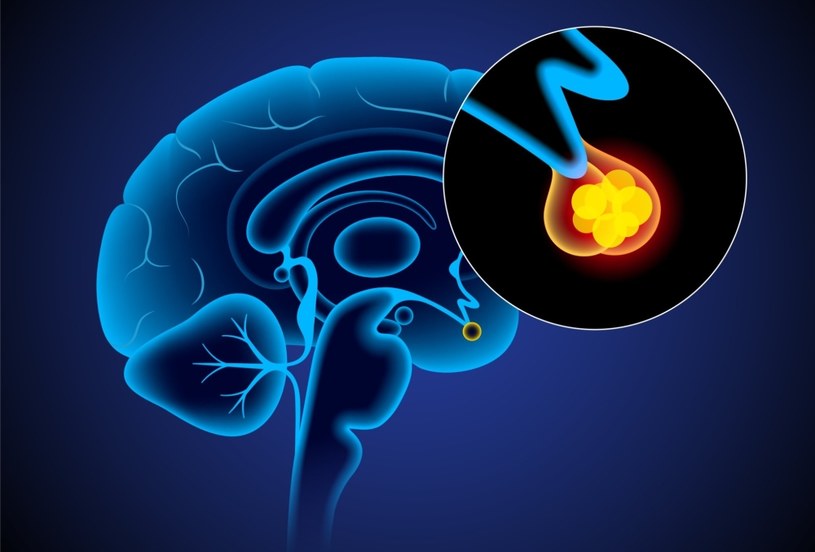Za produkcję hormonu wzrostu odpowiada maleńki gruczoł w mózgu - przysadka mózgowa. Guz w tym miejscu przyczynia się do rozowoju akromegalii /123RF/PICSEL
