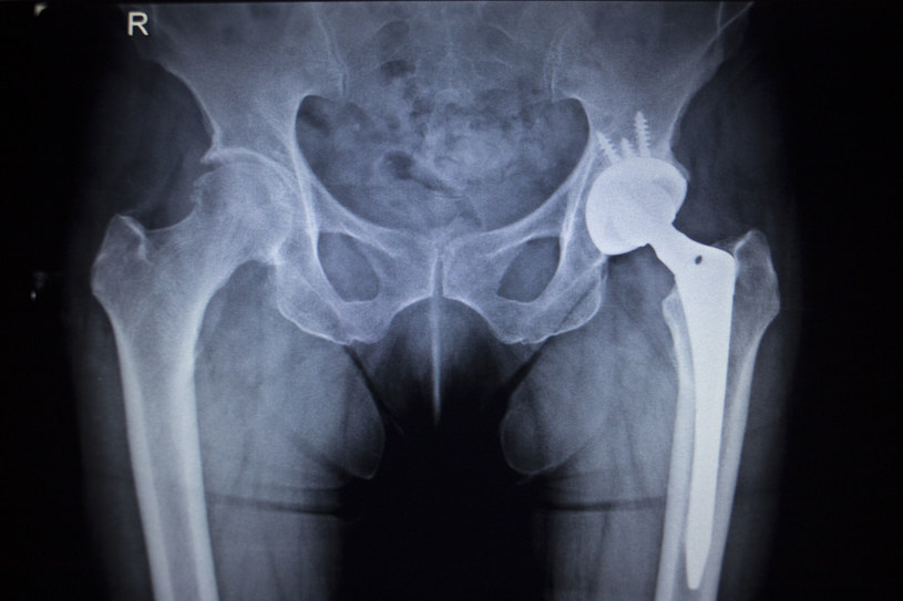 Zaawansowaną osteoporozę można wykryć podczas badania rtg /123RF/PICSEL