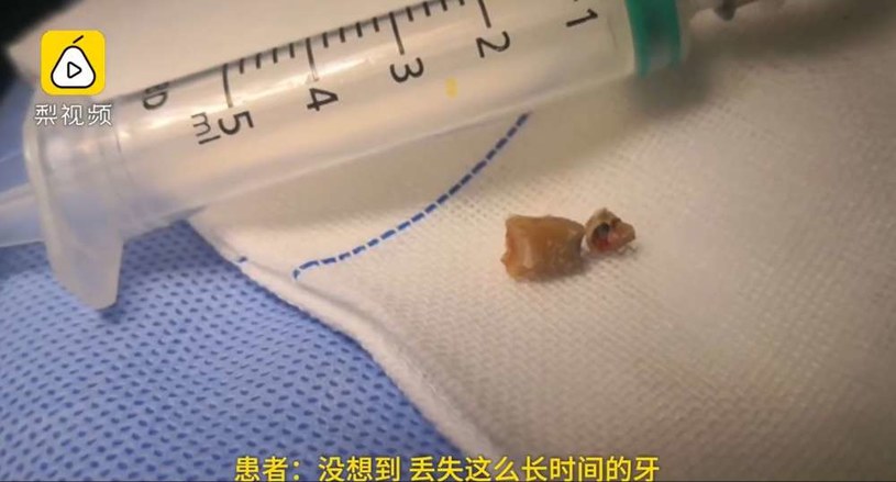Ząb wyciągnięty z jamy nosowej 30-letniego Chińczyka /materiały prasowe