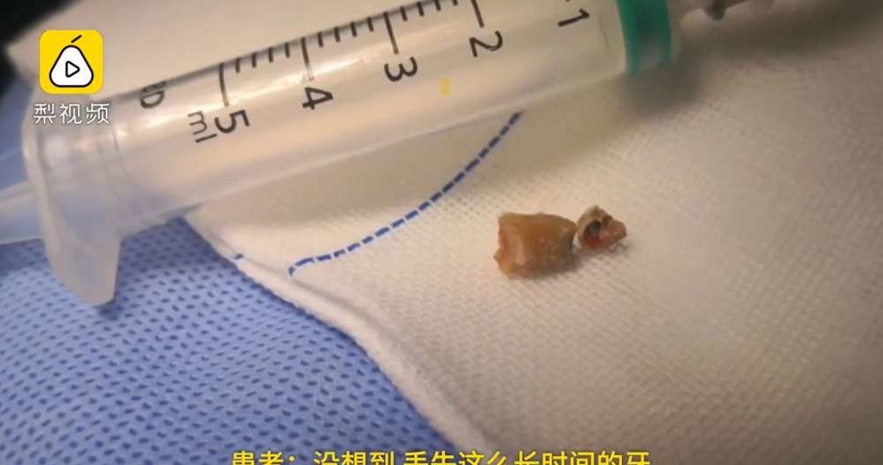 Ząb wyciągnięty z jamy nosowej 30-letniego Chińczyka /materiały prasowe