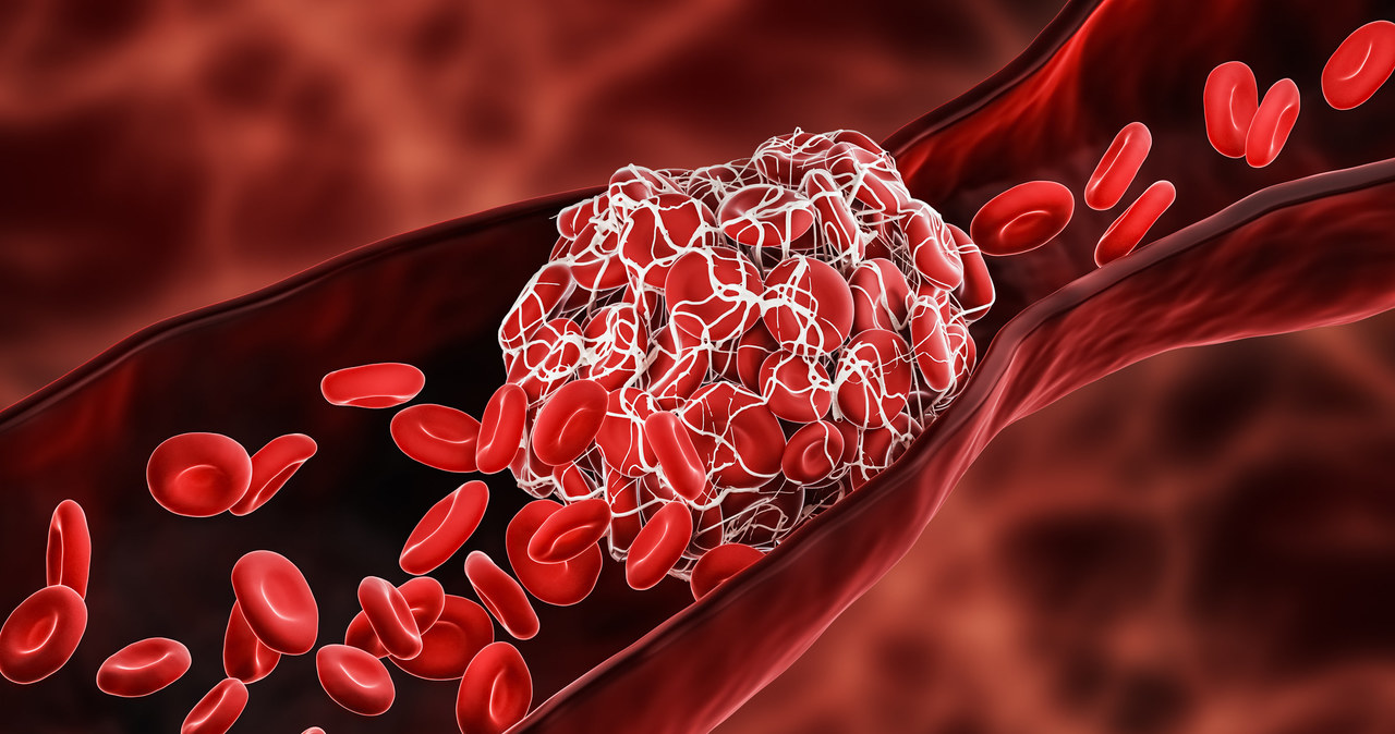 Zaburzenia krzepnięcia mogą być spowodowane wzrostem lepkości krwi lub jej utrudnionym przepływem przez naczynia krwionośne /123RF/PICSEL