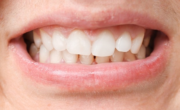 Zaciskanie zębów to bardzo szkodliwy nawyk. Ekspert radzi, jak z nim walczyć
