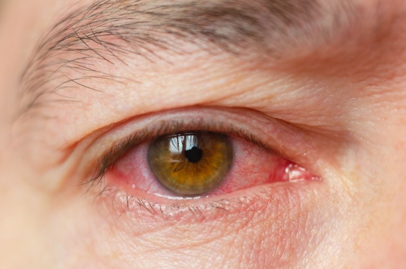 Zaczerwienienie spojówek to jeden z syndromów tzw. "oka biurowego" /123RF/PICSEL