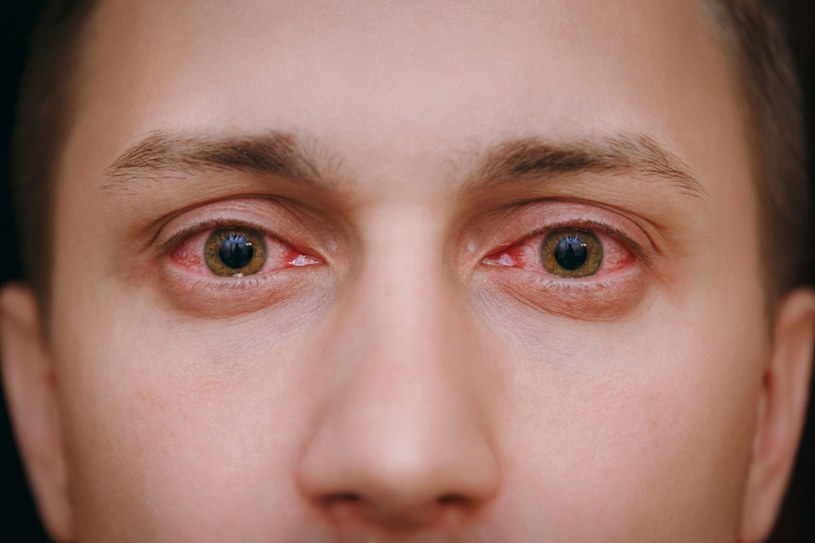 Zaczerwienione oczy i objawy grypopodobne? To może być alergia /123RF/PICSEL