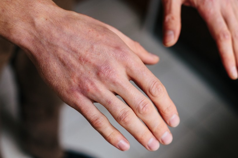 Zadbaj o dłonie, czerpiąc z naturalnej apteczki /123RF/PICSEL