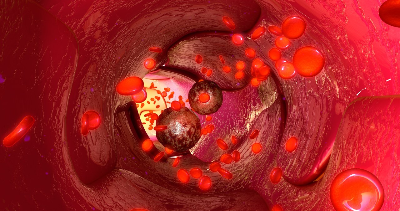Zahamowanie powstawania przerzutów to jeden z kluczowych etapów walki z nowotworami /123RF/PICSEL