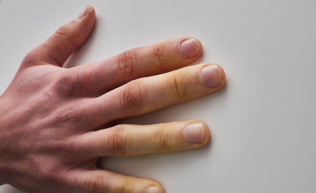 "Zamrożenie" w ciele. Ta choroba dotyka głównie młode kobiety