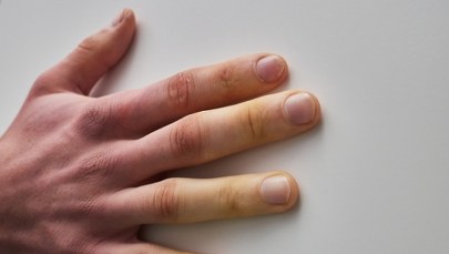 "Zamrożenie" w ciele. Ta choroba dotyka głównie młode kobiety