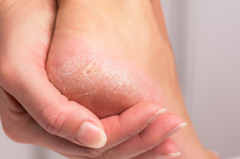 Zaniedbane suche pięty mogą prowadzić do uszkodzeń skóry właściwej /123RF/PICSEL