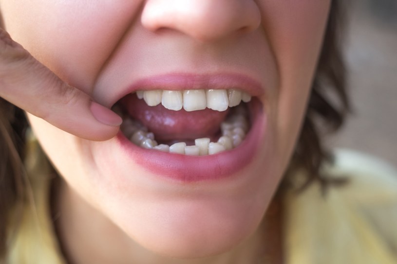 Zaniedbane zęby to oznaka niechlujnych i nie dbających o zdrowie ludzi. Nie rezygnuj z past z fluorem w imię nieudowodnionych teorii o jego szkodliwości w małych dawkach! /123RF/PICSEL