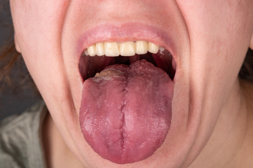 Zapalenie języka może być objawem niedoboru witamin /123RF/PICSEL