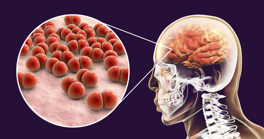 Zapalenie opon mózgowych /&copy;123RF/PICSEL