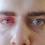 ​Zapalenie spojówek - przyczyny, objawy i sposoby leczenia zainfekowanego oka 
