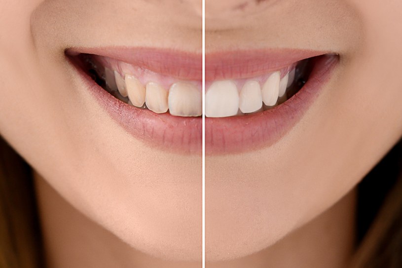 Zaskakująca przyczyna żółtych zębów. Higienistka przestrzega przed jednym