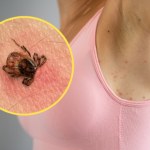 Zaskakujące, gdzie na ciele chowają się kleszcze. Nikt tam nie szuka