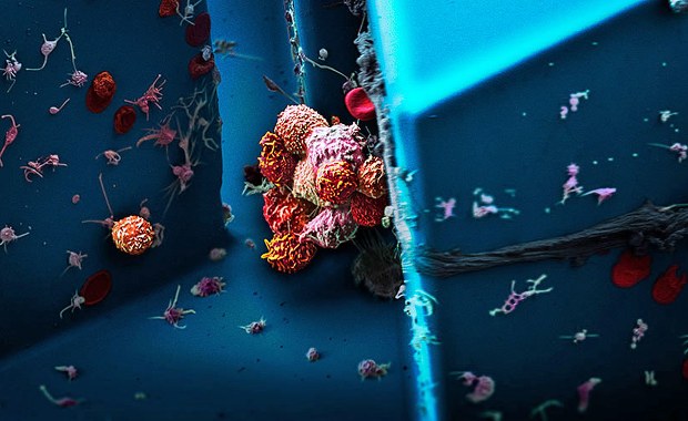 Zaskakujące odkrycie. To brak tlenu sprzyja przerzutom nowotworowym