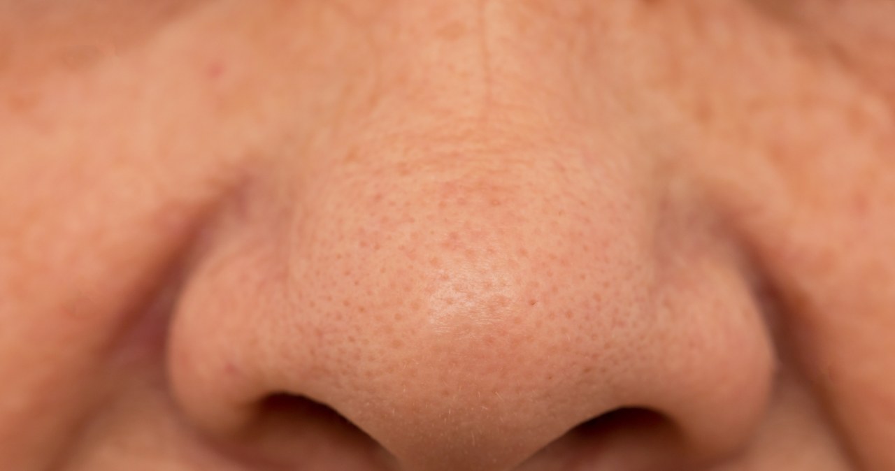 Zaskórniki znikną po zastosowaniu pasty z sody oczyszczonej /studybos /123RF/PICSEL