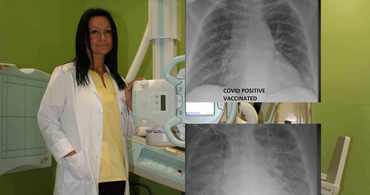 Zaszczepiony i niezaszczepiony z Covid-19. Radiolog opisuje RTG ich płuc 