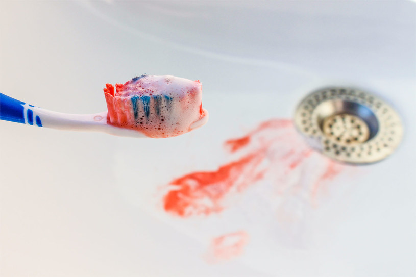 Zauważyłaś krew podczas mycia zębów? Możesz temu zaradzić! /123RF/PICSEL