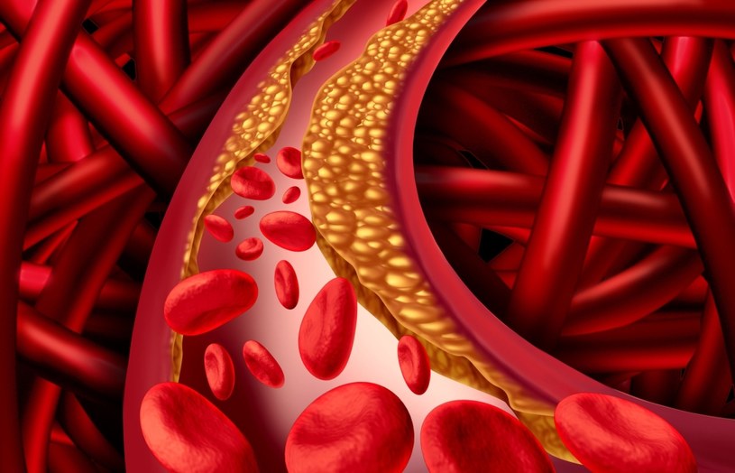 Zawarty w awokado potas zapobiega wapnieniu ścianek naczyń krwionośnych /123RF/PICSEL