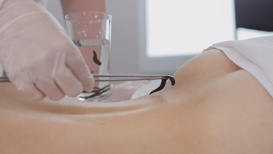 zdj. ilustracyjne / Lecznicza moc pijawek medycznych – hirudoterapia wraca do łask /Shutterstock