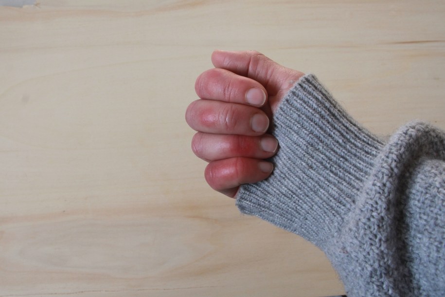 zdj. ilustracyjne/Zima atakuje skórę. Czas na odmrożenia i oparzenia /Shutterstock