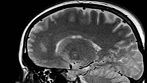 ​Lepsze ukrwienie mózgu może spowolnić rozwój choroby Alzheimera