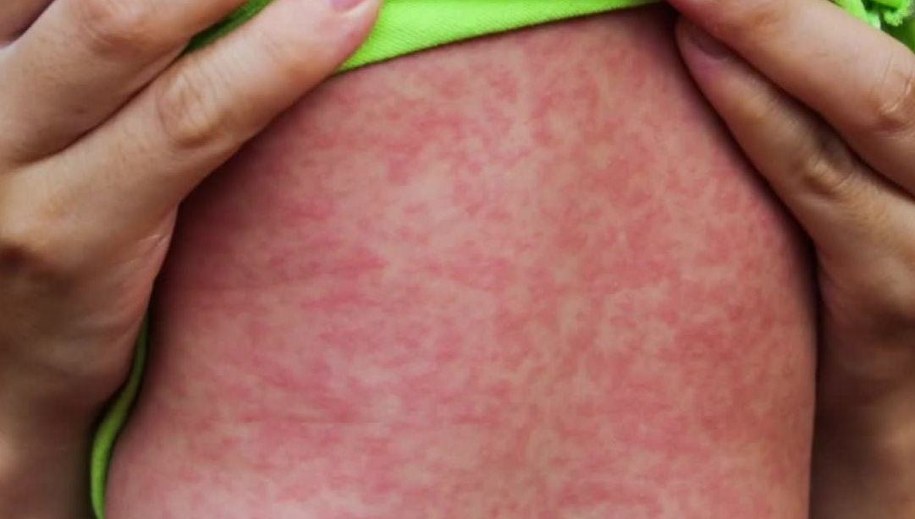 Gwałtowny wzrost zachorowań na odrę w USA