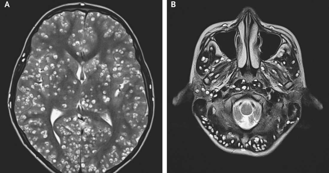 Zdjęcia skanów mózgu pacjenta zarażonego tasiemcem /Fot. The New England Journal of Medicine /materiały prasowe