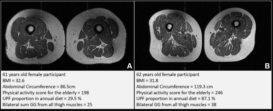 Zdjęcia z badania Ultra-processed Foods and Muscle Fat Infiltration at Thigh MRI: Data from the Osteoarthritis Initiative /Radiological Society of North America (RSNA) /Materiały prasowe