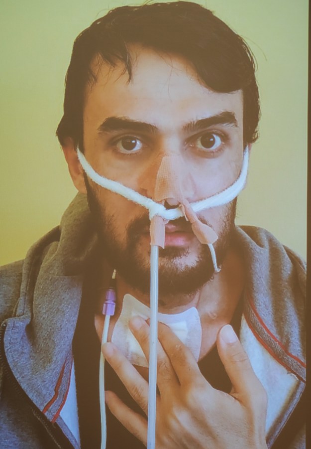 Zdjęcie 31-letniego pacjenta, cierpiącego wcześniej na raka krtani, u którego przeprowadzono transplantację narządów szyi /Hanna Bardo /PAP