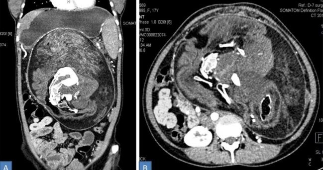 Zdjęcie CT ujawniło dużą masę komórek w jamie brzusznej nastolatki /materiały prasowe