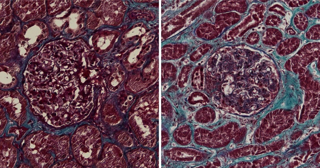 Zdjęcie histologiczne nerek - po lewej tkanka zdrowa, po prawej zmieniona przez SARS-CoV-2 (widoczne liczne zwłóknienia) /materiały prasowe