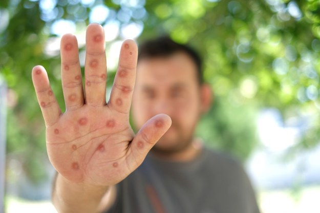 Pierwszy przypadek nowego wariantu małpiej ospy w Niemczech. Polskie służby uspokajają