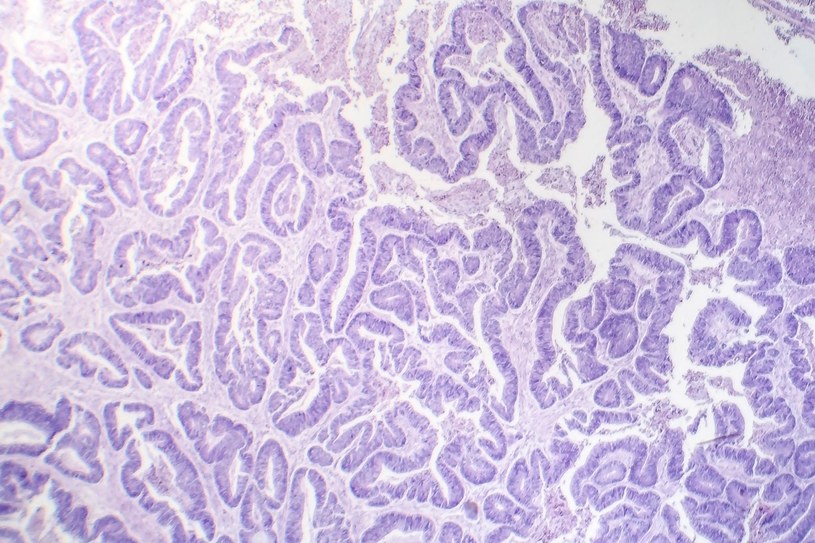 Zdjęcie mikroskopowe raka przełyku /123RF/PICSEL