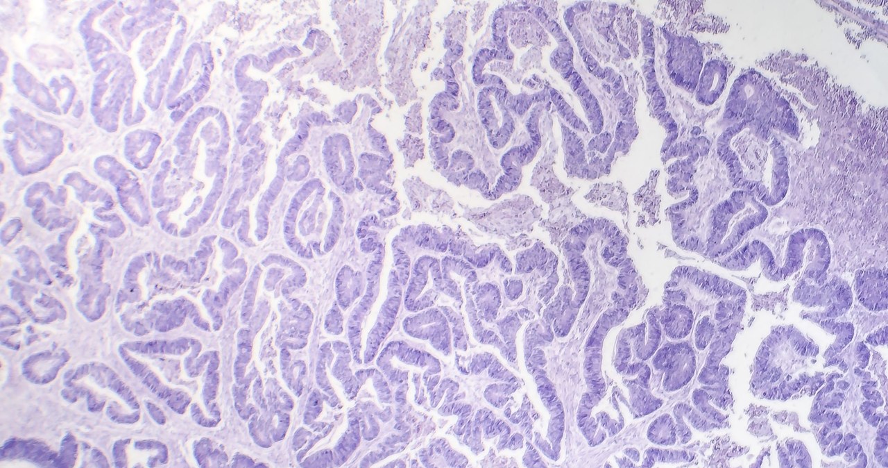Zdjęcie mikroskopowe raka przełyku /123RF/PICSEL