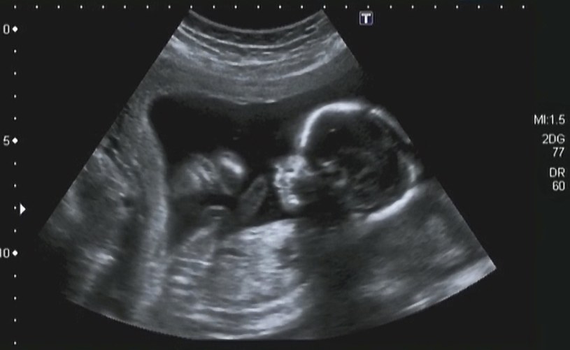 Zdjęcie poglądowe. Zdrowy płód około 4 miesiąca ciąży. W przypadku dziecka z Zespołem Edwardsa w obrazie USG widoczne są liczne wady rozwojowe /123RF/PICSEL