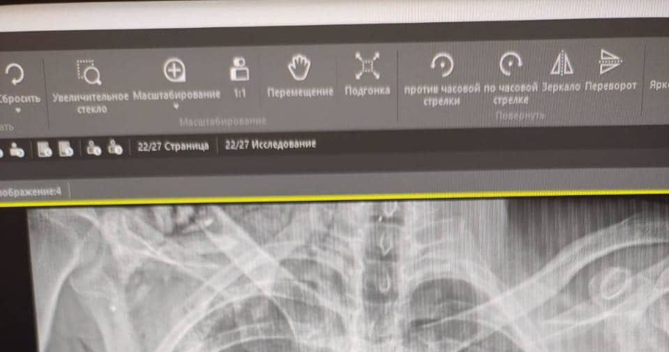 Zdjęcie rentgenowskie klatki piersiowej żołnierza z widocznym granatem /Dowództwo Sił Medycznych Sił Zbrojnych Ukrainy