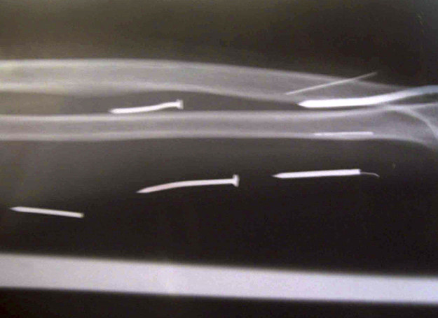 Zdjęcie rentgenowskie nogi L.T. Ariyawathi z widocznymi gwoździami i igłami /AFP