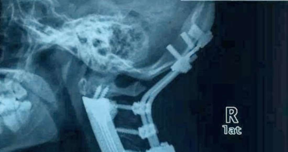 Zdjęcie rentgenowskie pacjentki po operacji /materiały prasowe