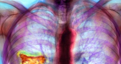 Zdjęcie rentgenowskie płuc osoby chorej na azbestozę. Fot. DU CANE /Agencja SE/East News