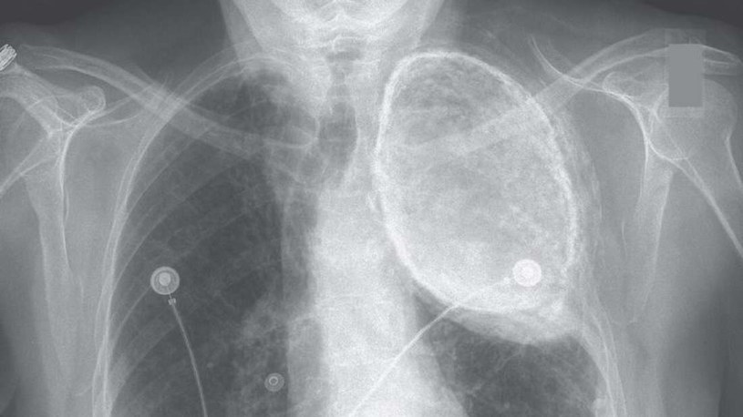 Zdjęcie rentgenowskie pokazujące olej w jednym z płuc opisywanej kobiety /materiały prasowe